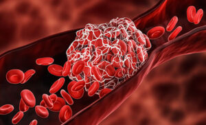 Big Health messaging: Anybody can get a blood clot and don’t ask why